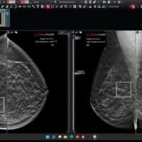 breast cancer AI Delaware Breast Cancer Coalition